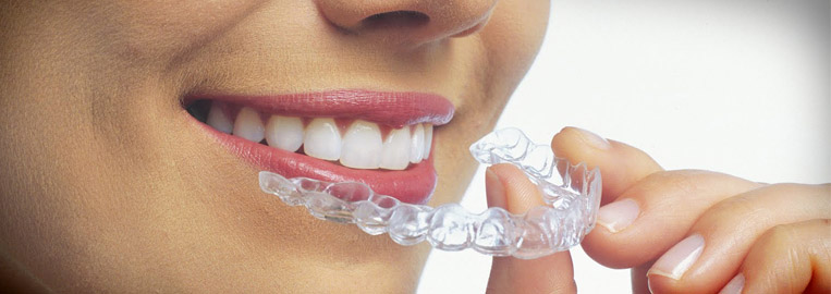 invisalign-wide